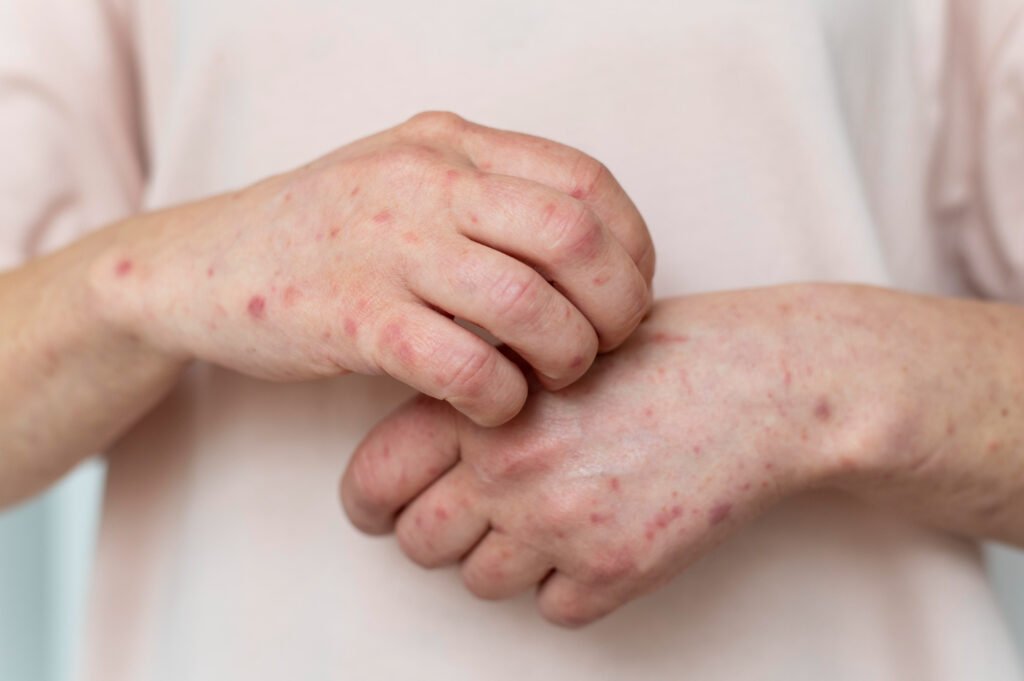 Dermatite Conceito, Tipos, Causas, Sintomas E Tratamentos