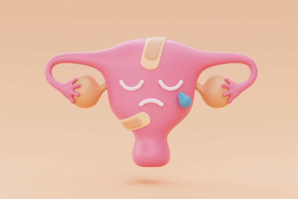 Endometriose: Sintomas, Diagnóstico E Acompanhamento Médico Para Melhor Qualidade De Vida 1 Endometriose Infecções Ginecológicas