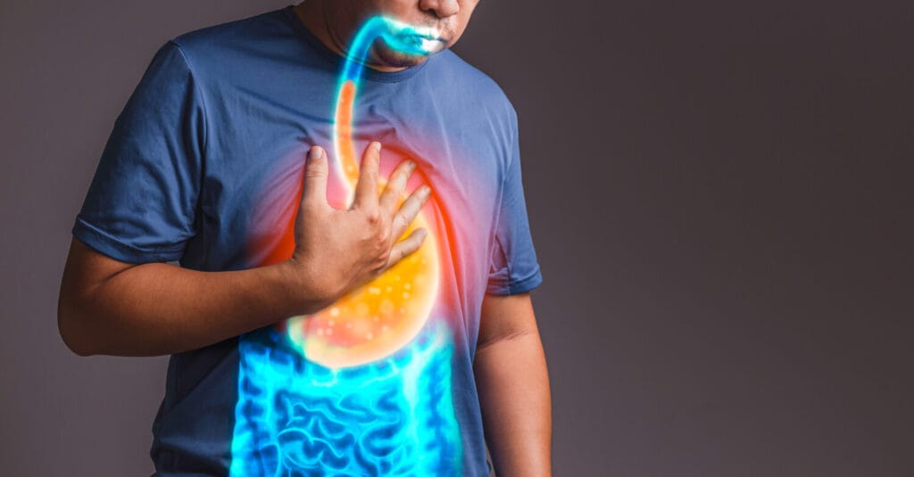 Quando A Azia Frequente Pode Indicar Problemas Gastrointestinais 1 Azia