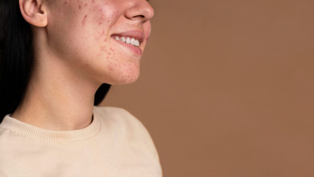 Acne Adulta