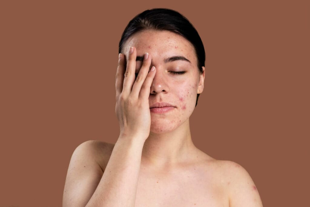 Acne Adulta