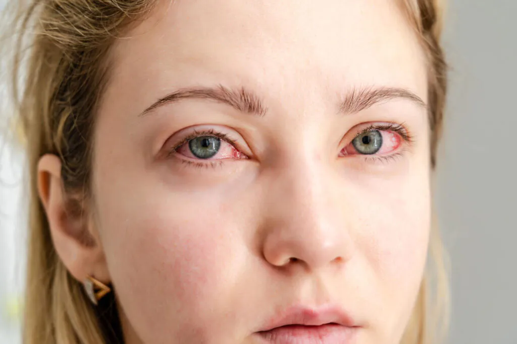 Olhos Vermelhos