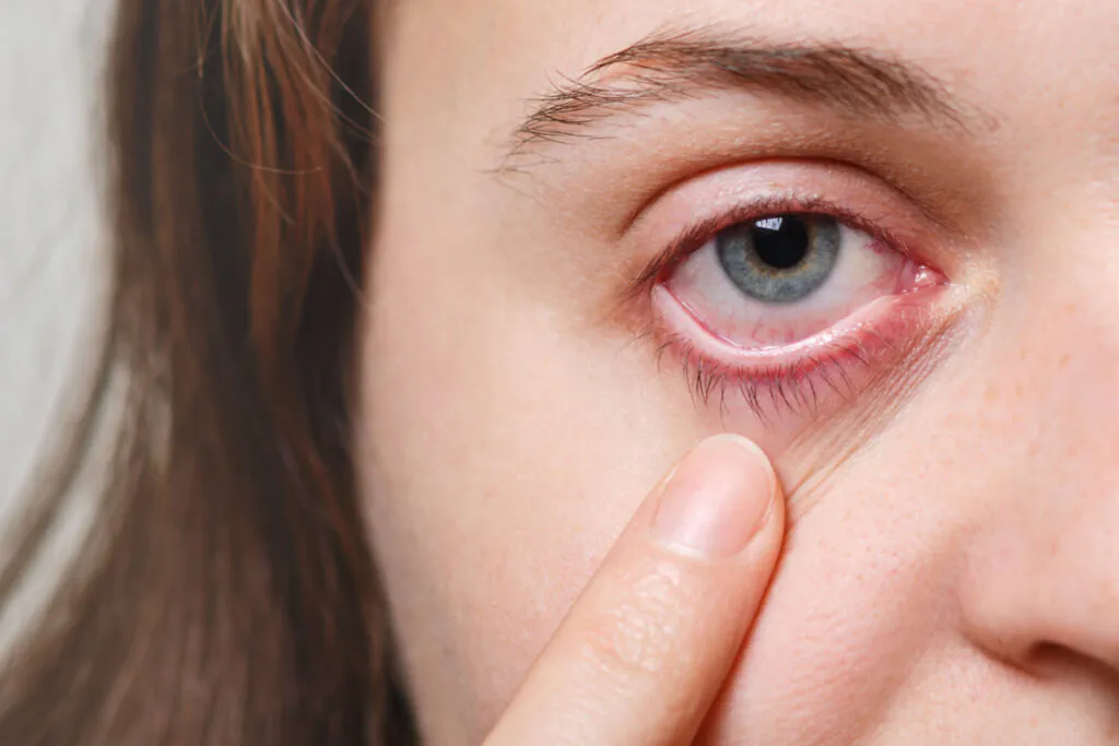 Olhos Vermelhos