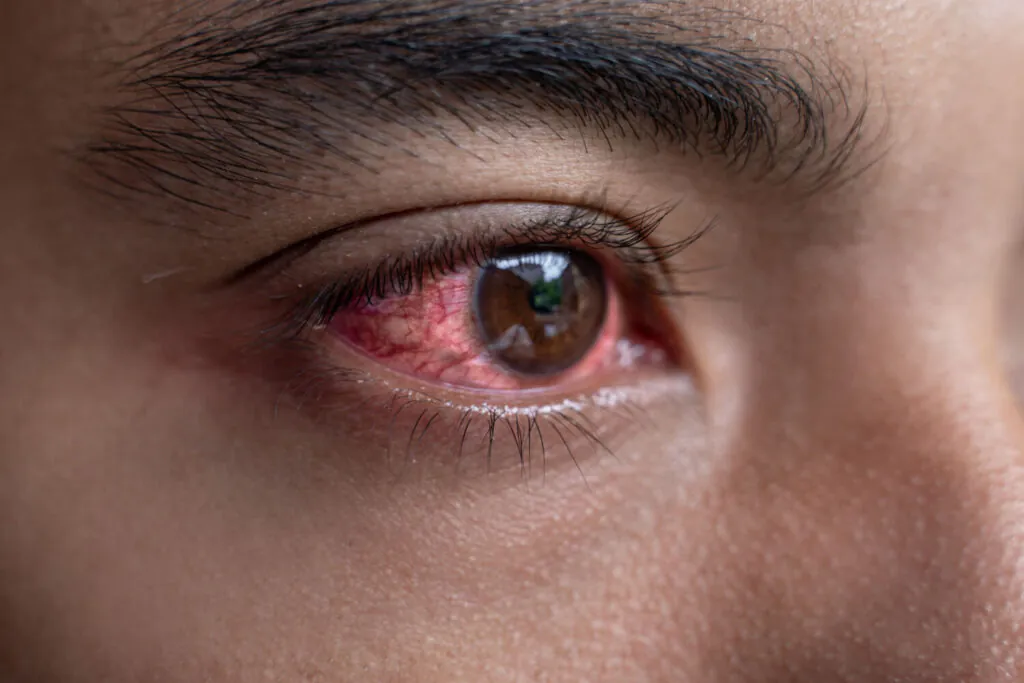 Olhos Vermelhos
